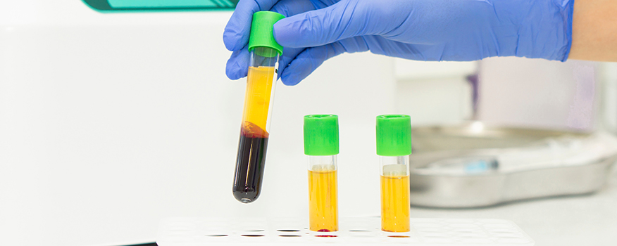 PRP therapy treatment being prepared at a regenerative medicine clinic in Redondo Beach