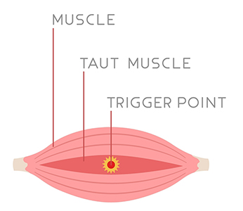 trigger points torrance